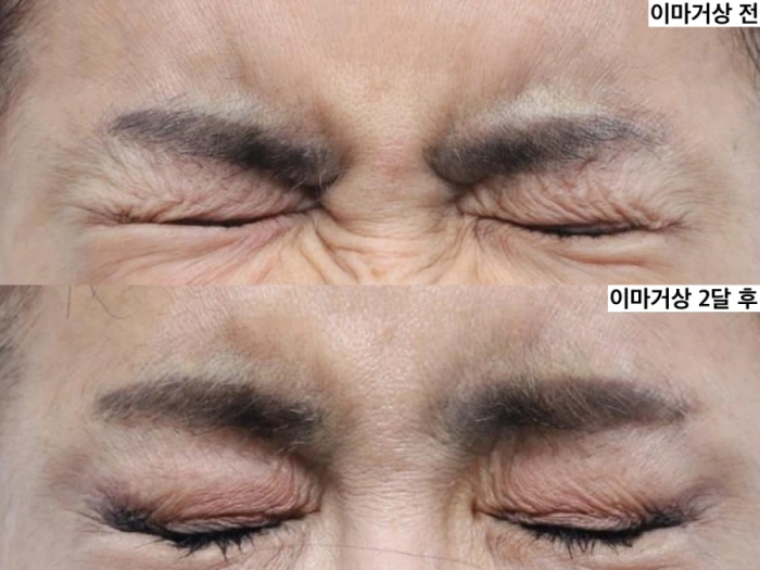 术前与术后2个月期间皱眉时眉间肌状态对比