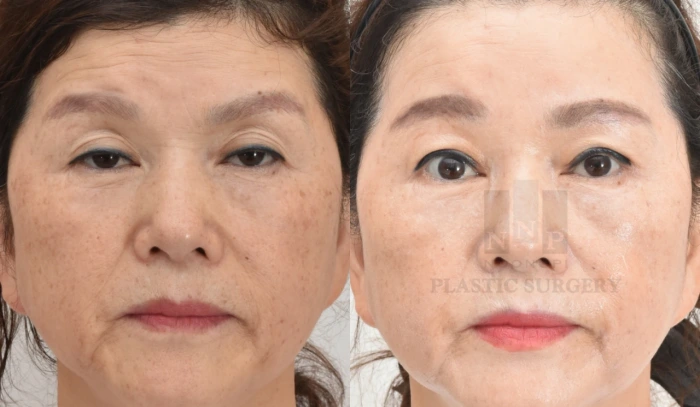 提眉术与双眼皮手术联合案例