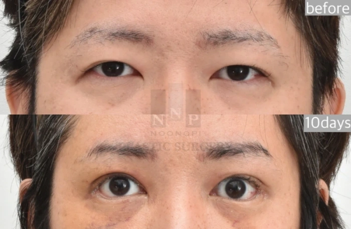 眼睑下垂手术后改善睡眼状态