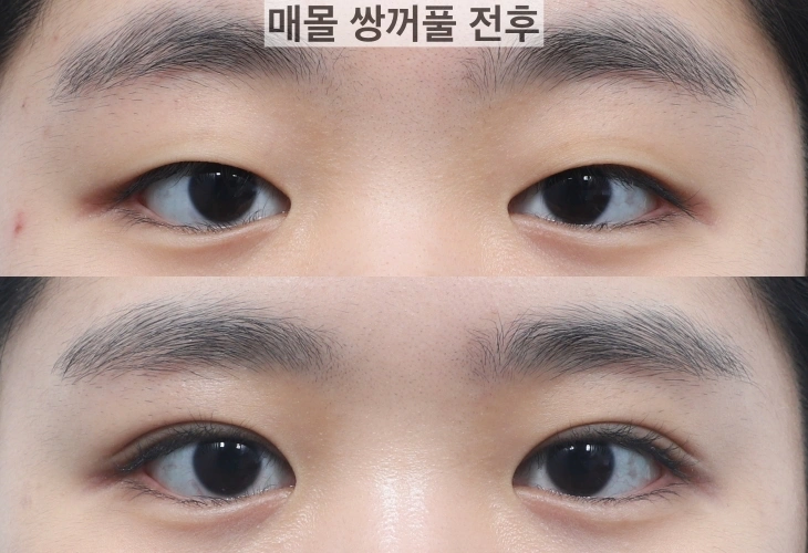 non-incisional double eyelid surgery Korea