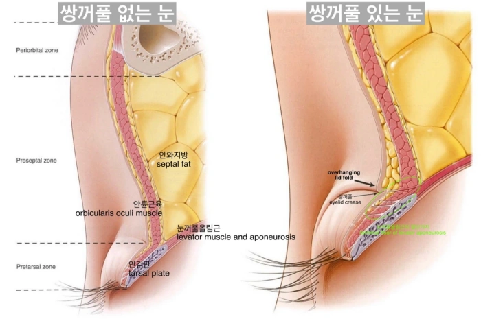 쌍꺼풀 수술 원리