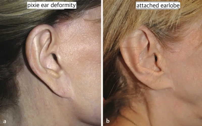 تشوه شحمة الأذن بعد عملية شد الوجه: الأذن الصغيرة مقابل الأذن الملتصقة (المرجع: كتاب Neligen)