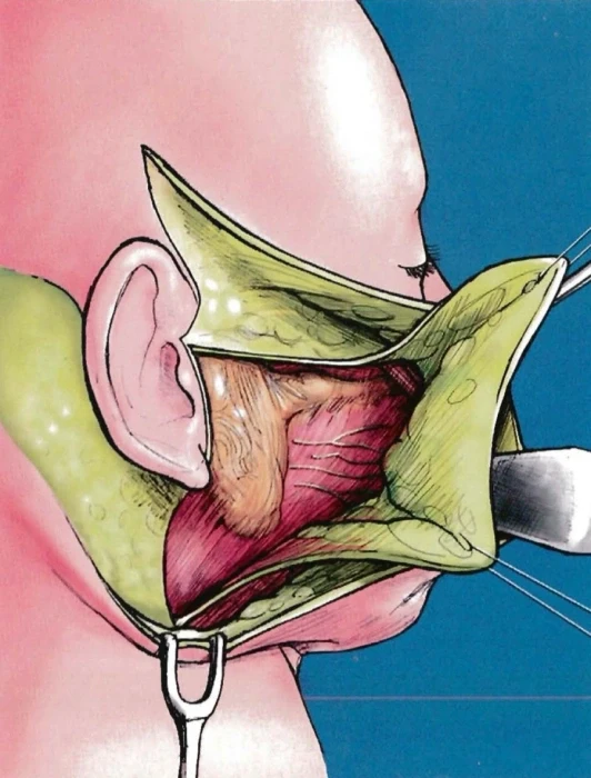 双平面分离高位SMAS面部提升术