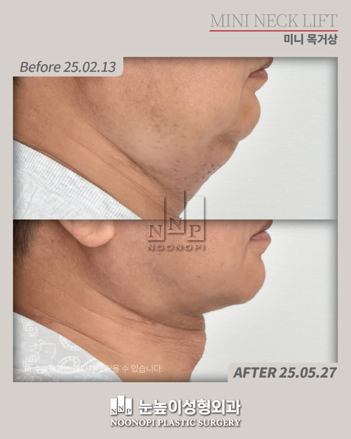 جراحة الذقن المزدوجة في كوريا