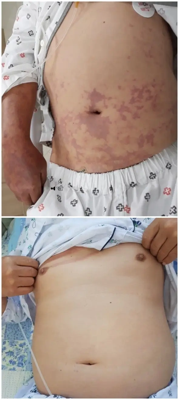 العلاج بالأكسجين عالي الضغط (HBOT) لعلاج مرض تخفيف الضغط