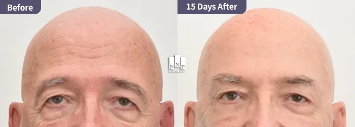 direct brow lift showing the arched brow preference in Caucasian Western eyelid surgery Korea