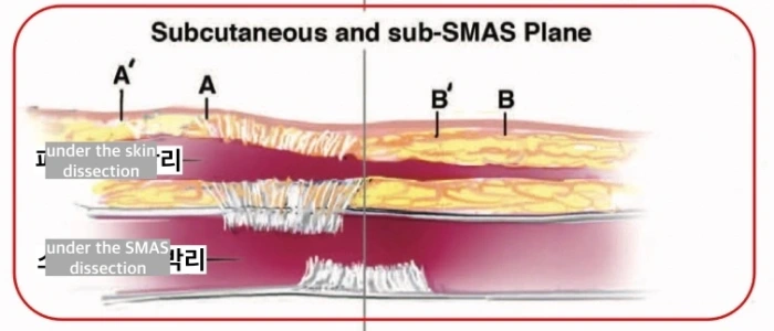 双平面面部提升术概述