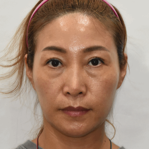 눈밑 지방 재배치 1달 뒤 모습