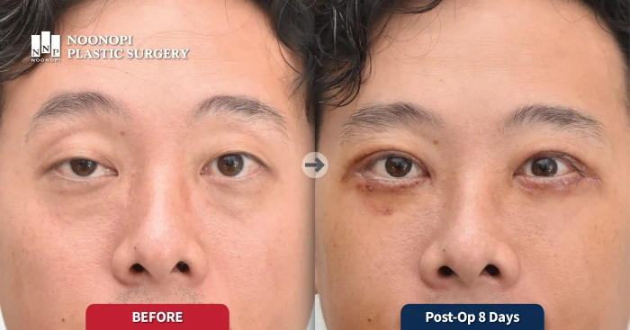 male ptosis surgery results in Korean plastic surgery clinic