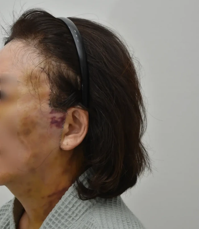 리팅성형외과에서 부적절한 절개리프팅 후 어색해진 헤어라인 사례
