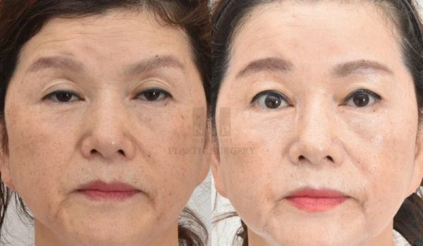 联合上睑成形术的眉部提升术前后对比