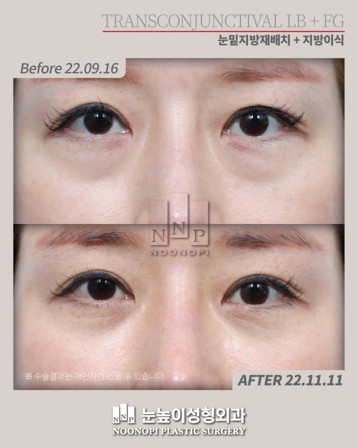 下眼睑脂肪移植联合下睑成形术