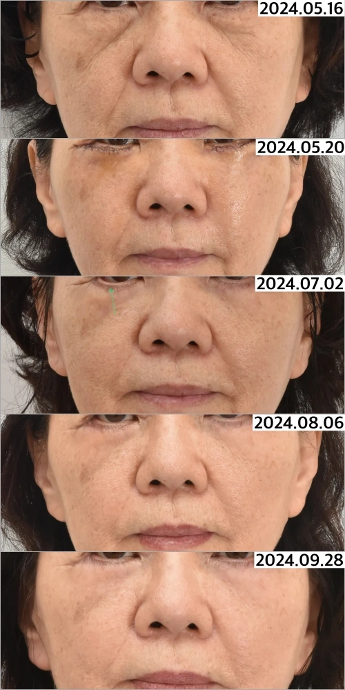 أجريت لها عملية تجميل الجفن السفلي الثانوية في عيادة نونوبي. وفي يوليو، أجرينا شد الزاوية الخارجية للعين لإعادة بناء انقلاب الجفن