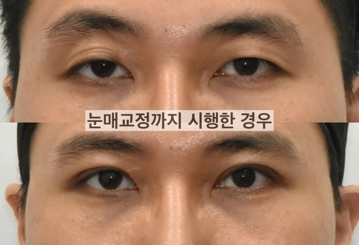 当眼睑矫正与双眼皮手术同步进行时