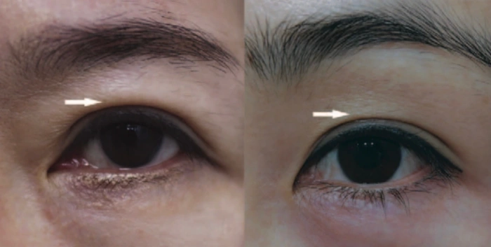upper eyelid skin thickness