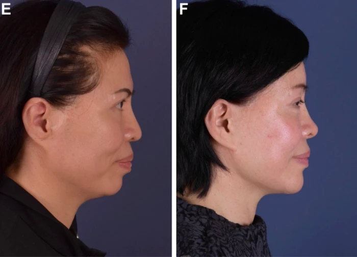 photo of attached earlobe after facelift