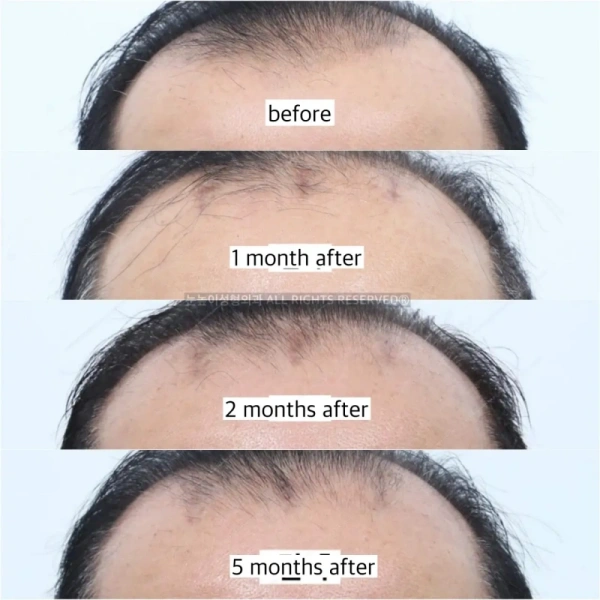 brow lift balding patient