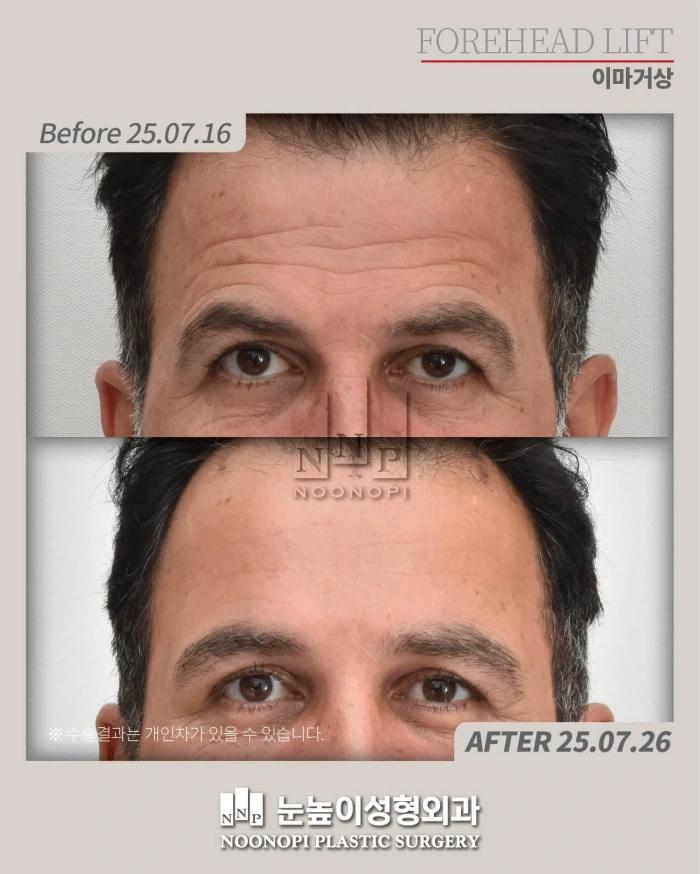 endotine额部提拉术术前术后对比