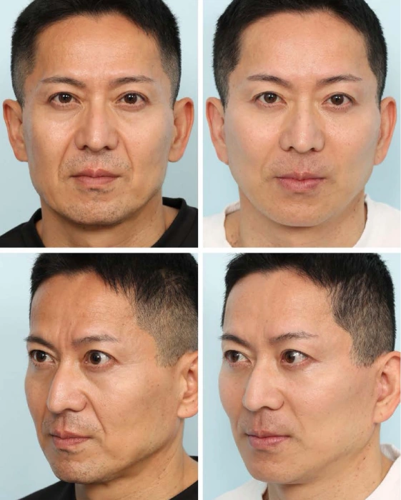 Before and after from Chin-Ho Wong's paper in the Mendelson lineage