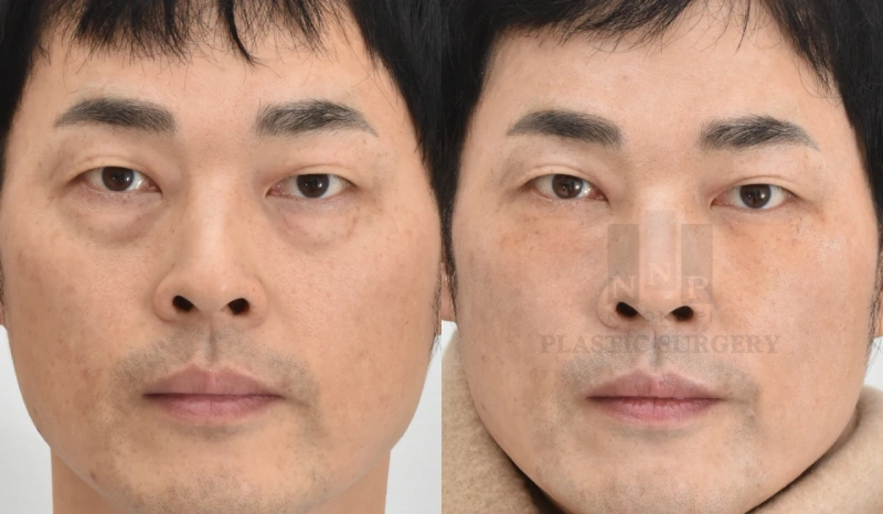 祛眼袋手术需要恢复多久