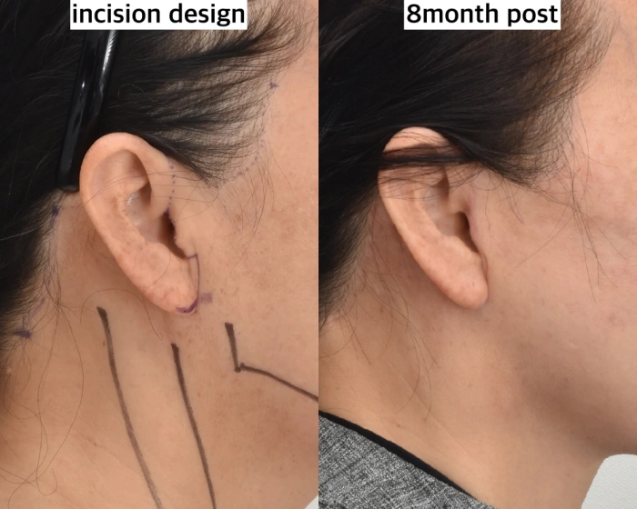 facelift incision placement
