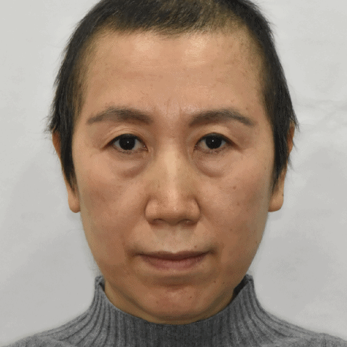 下睑提升术6个月后