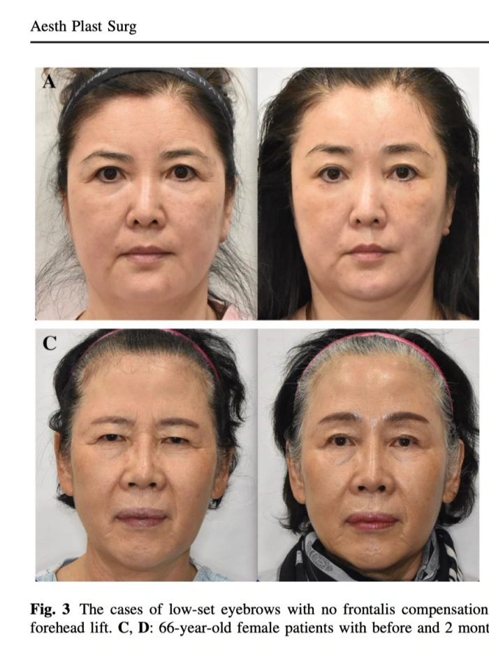 내시경이마거상 전후 사진