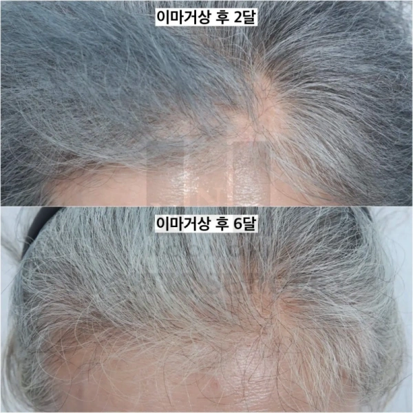 额部提升术脱发案例:随时间恢复