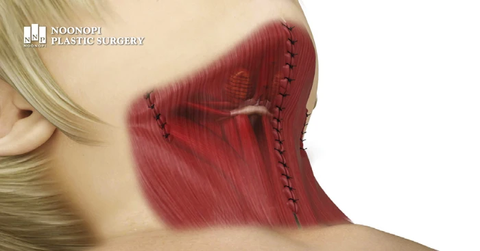 이중턱근육묶기 일러스트레이션