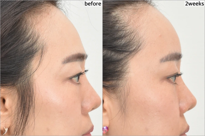 زرع الدهون في الجبهة قبل وبعد