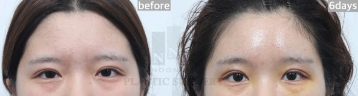 절개 눈매교정과 이마거상 6일 후