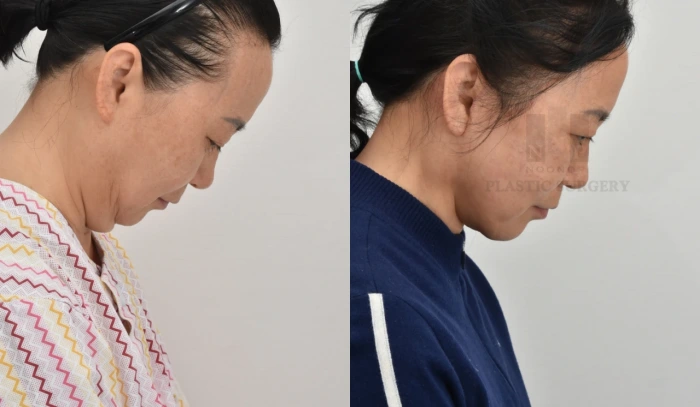 Result after combined neck and facelift in 60s