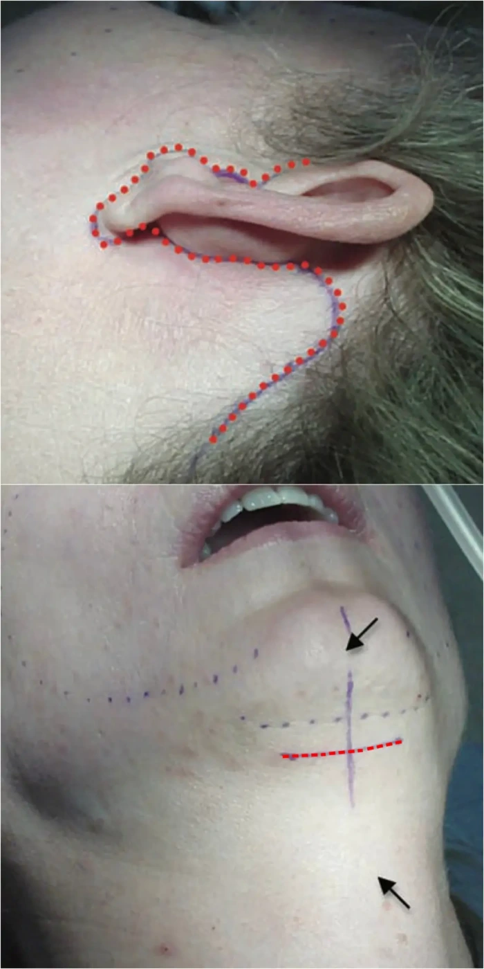 full neck lift incision location