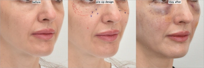 眼下脂肪注射后第二天的效果