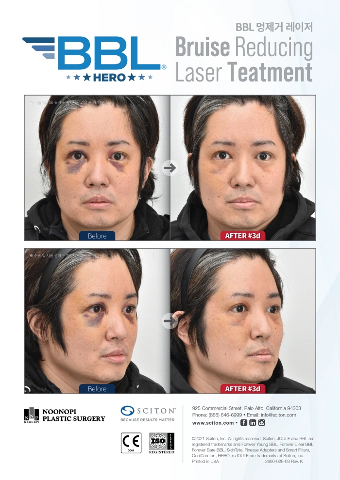 멍레이저 전후 효과