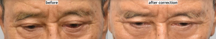 外翻矫正后左眼睑与眼球间隙（绿箭头）消失