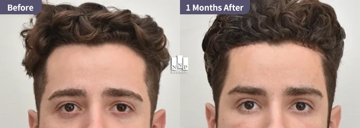 Example of a fox eye lift showing the arched brow preference in Caucasian Western eyelid surgery Korea