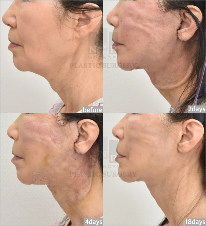 多数皮肤不平整现象将随自然愈合过程逐渐消退。