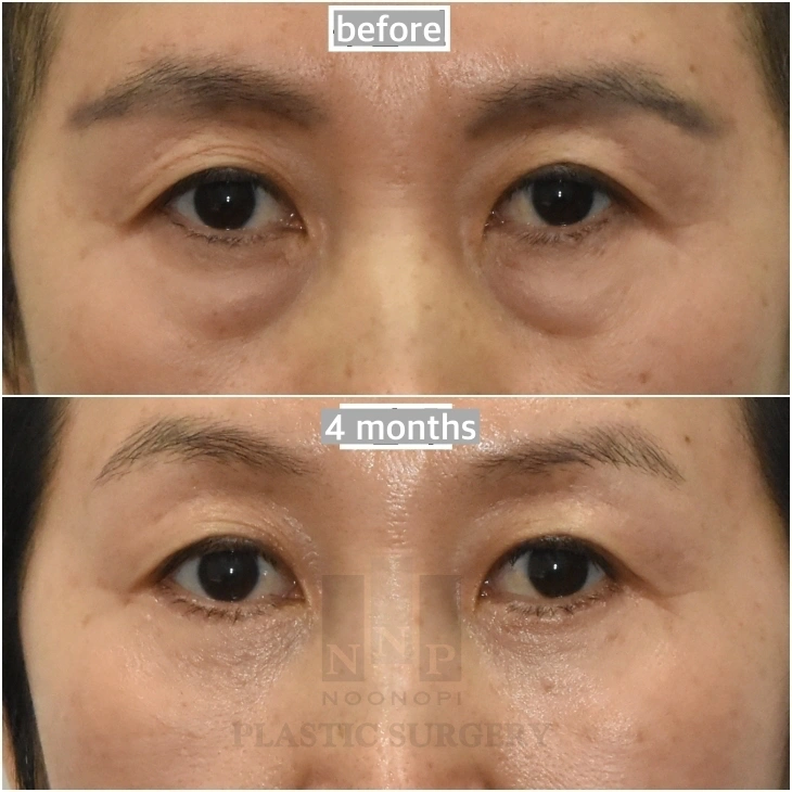 جراحة الجفن السفلي قبل 4 أشهر وبعدها