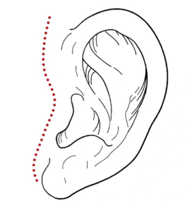 anterior tragus incision in facelift