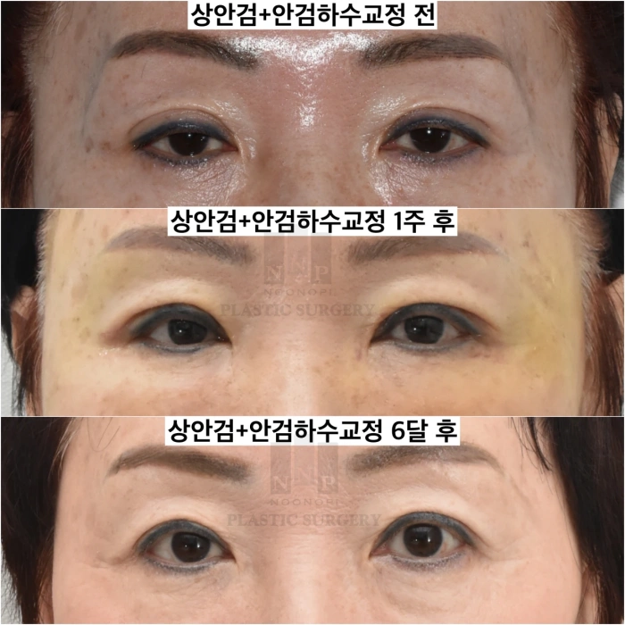 矫正睡眼外观术后1周及6个月