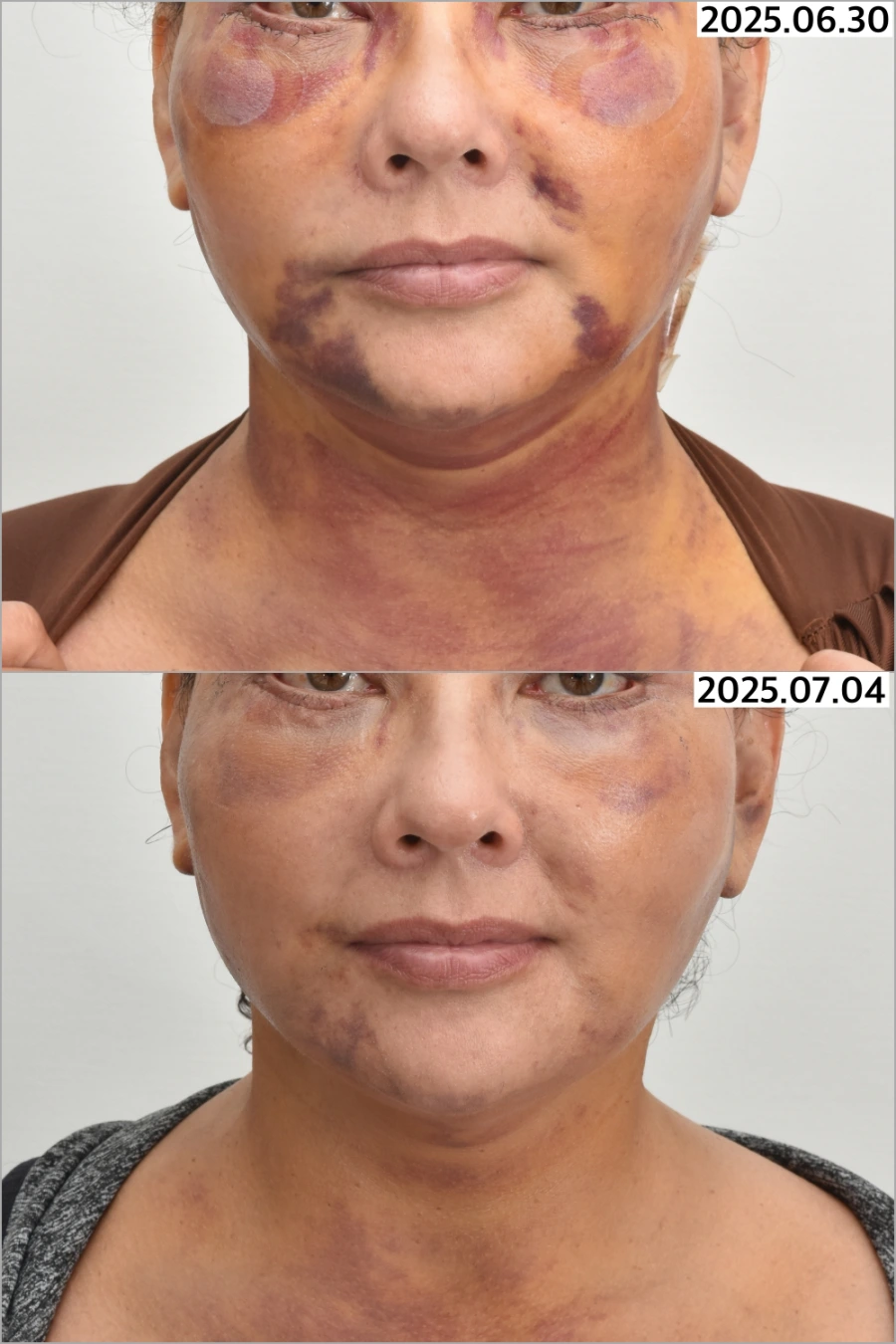 hyperbaric oxygen therapy before after