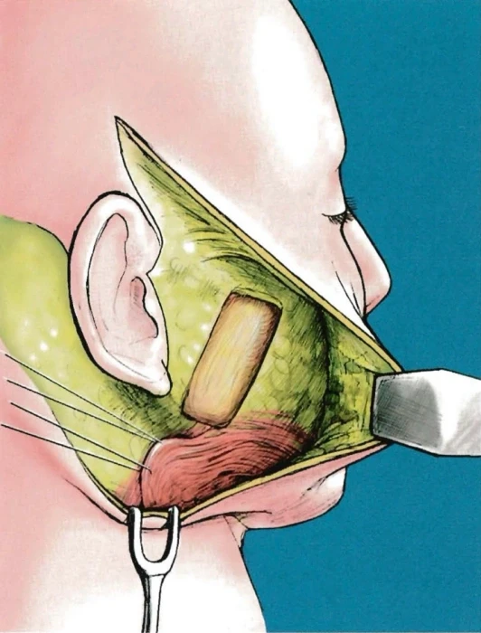استئصال SMAS الجانبي
