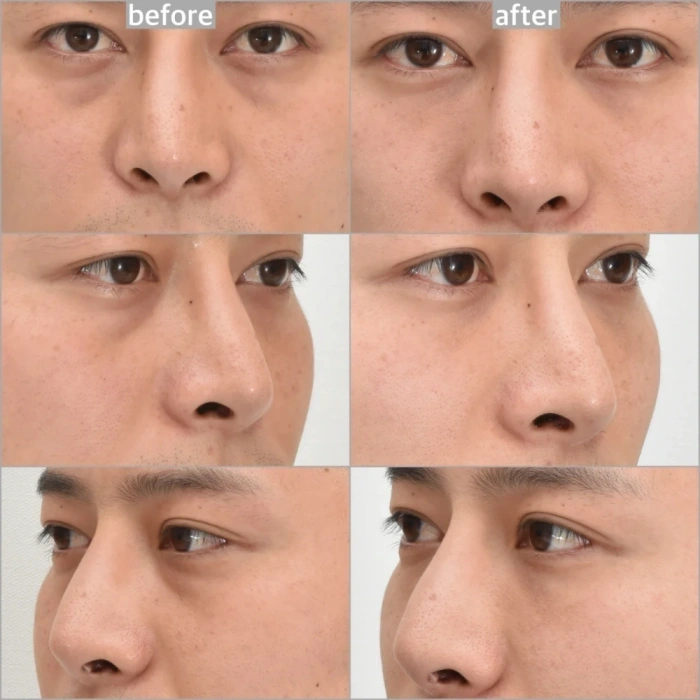 جراحة الهالات السوداء في كوريا