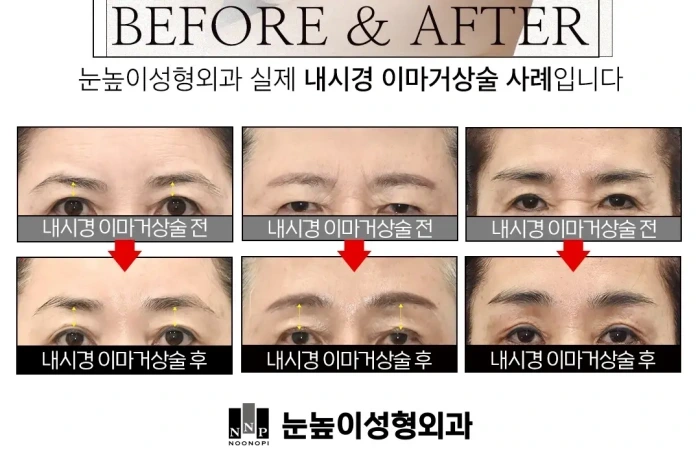 Before & after brow lift results