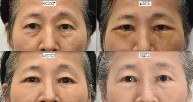 أجرى الدكتور نك بارك عملية تجميل الجفن السفلي لوالدته: جدول زمني للتعافي