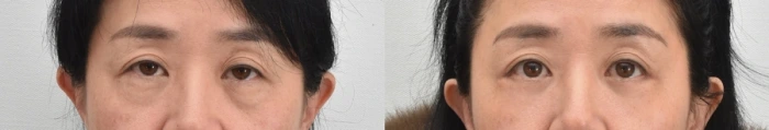 눈밑 꺼짐이 개선된 하안검성형 2달 후 전후 모습