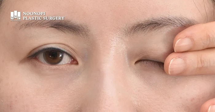 Explanation of Hering's Law in asymmetric eye surgery