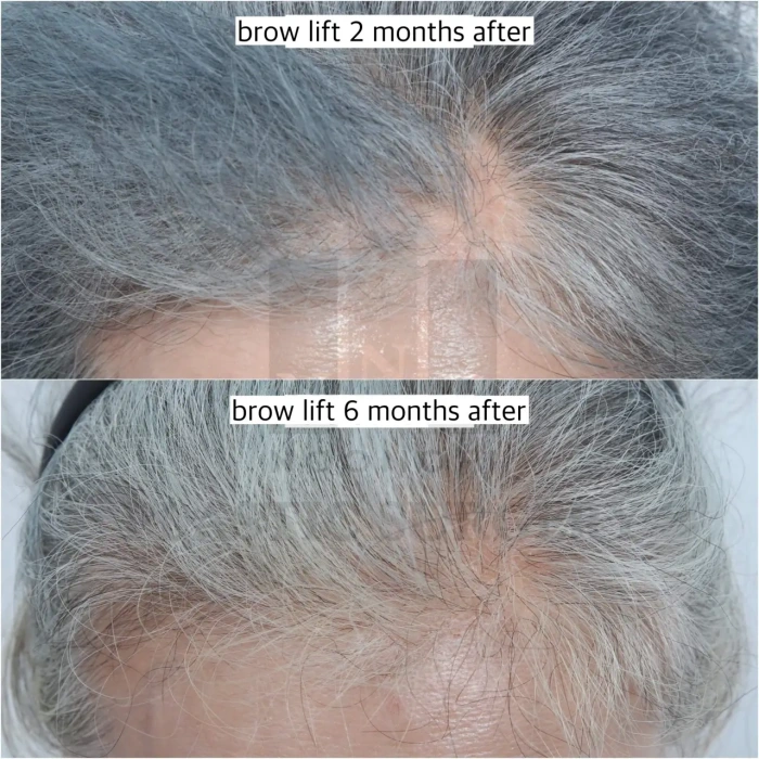 temporary hair loss may recover without any treatment