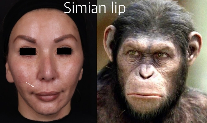 مثال على مظهر غير طبيعي ومفرط النتوء ناتج عن حشو مفرط للطيات الأنفية الشفوية التي انتقلت إلى منطقة الشفة العليا.